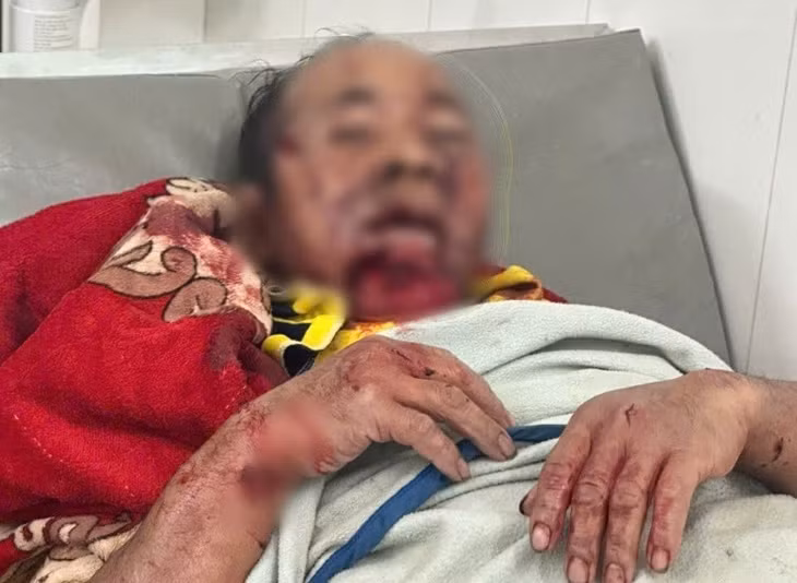 Trưởng thôn ở Đà Nẵng bị gấu rừng tấn công giữa đường vắng, thoát chết trong gang tấc. Ảnh: Hồng Anh