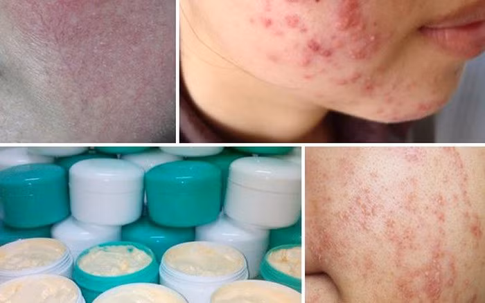 Hậu quả trên da do sử dụng kem trộn chứa corticoid.