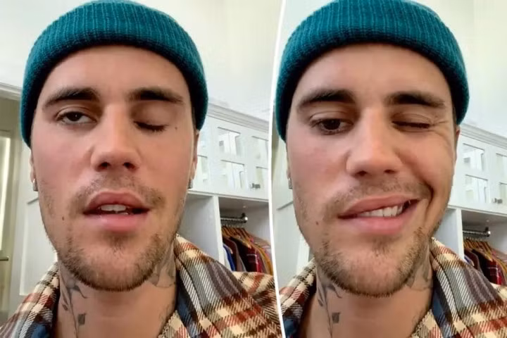 Justin Bieber không thể cử động một bên mặt.