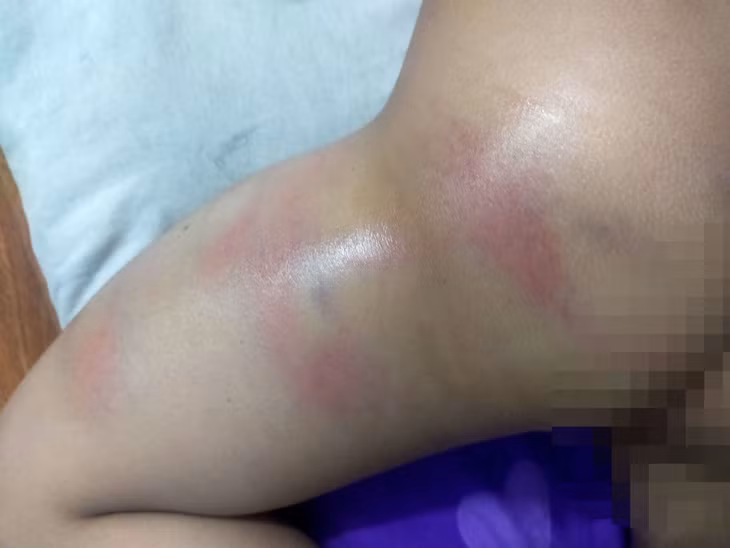 Hình ảnh chân bé gái 4 tuổi bị bầm tím. Ảnh: TTXVN phát