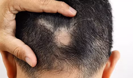 Thuốc bôi, thuốc tiêm và thuốc uống đều là những lựa chọn khả thi để giúp điều trị chứng rụng tóc từng mảng.