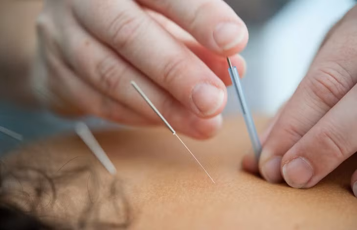 Châm cứu là một trong những phương pháp điều trị thay thế khi bị thoái hóa cột sống thắt lưng. Ảnh minh họa: katherine_hanlon.