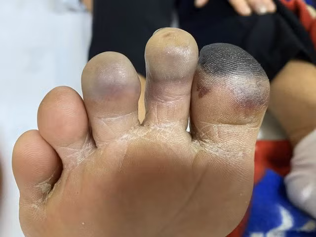 Tổn thương ngón chân xanh tím và đau buốt của hiện tượng Raynaud