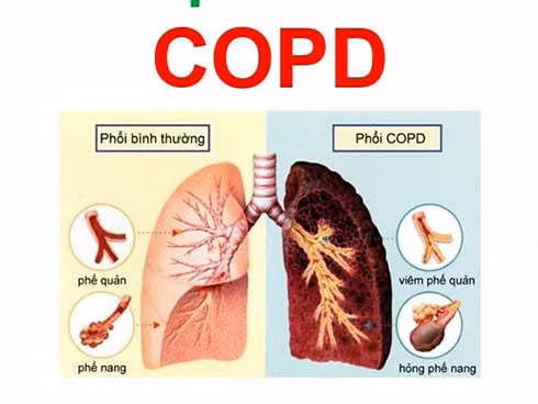Bệnh phổi tắc nghẽn mạn tính có thể gây nhiều hệ lụy nghiêm trọng cho người bệnh.