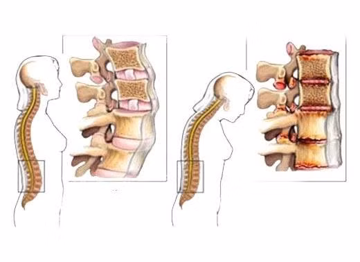 Hình ảnh mô phỏng cột sống lưng bị thoái hóa. Ảnh: BVCC.