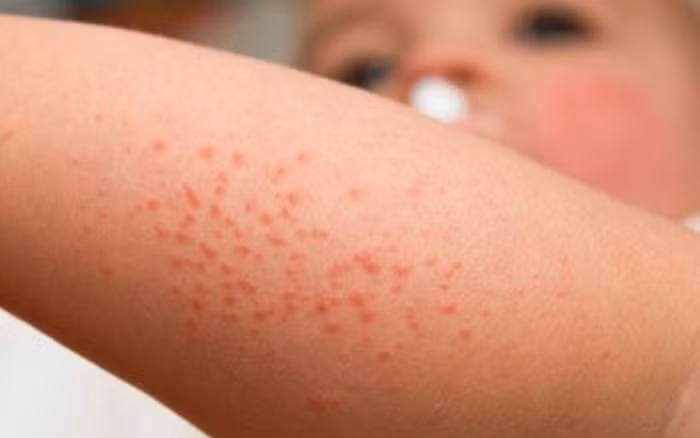 Cách phòng ngừa các bệnh về da vào mùa đông ảnh 1