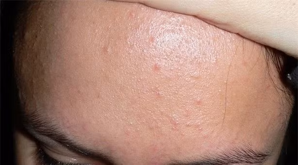 Bạn có thể tự điều trị mụn ẩn dưới da tại nhà. mụn ẩn dưới da