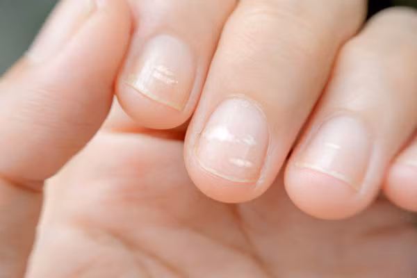 Không phải xem chỉ tay, nhìn móng tay của mình thuộc loại nào trong 7 kiểu dưới đây sẽ giúp bạn đoán được sức khỏe của bản thân - Ảnh 3.