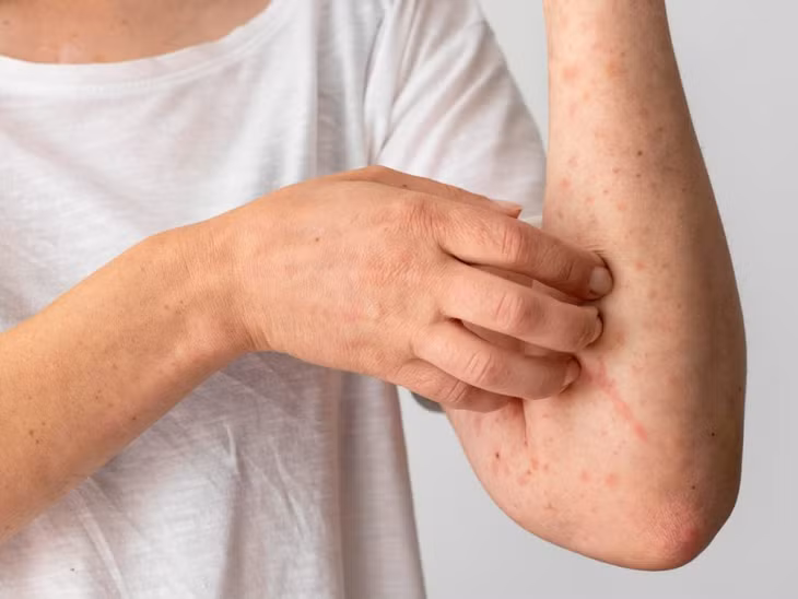Viêm da do cơ địa thường gây ngứa và vô cùng khó chịu cho người bệnh.