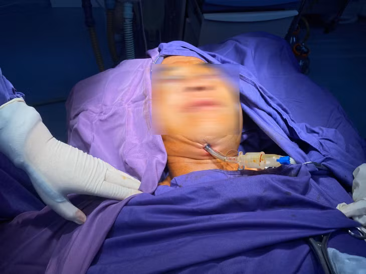Với kỹ thuật đặt nội khí quản dưới cằm thì sẹo ở vị trí khuất, tính thẩm mỹ cao.
