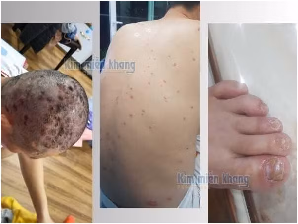 Bệnh vảy nến của anh Đại ngày một nặng và lan ra khắp người