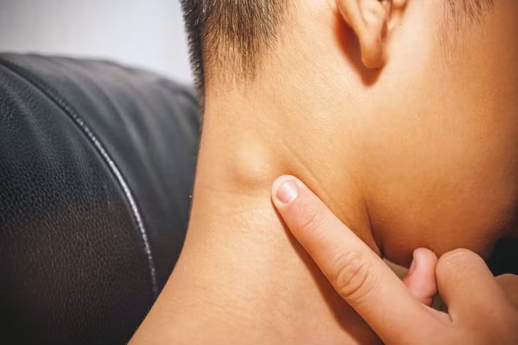 Qua theo dõi bằng siêu âm, đa số các hạch trở lại hình ảnh siêu âm hạch bình thường trong 60 ngày.