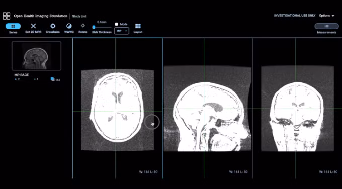 Phần mềm sử dụng ảnh cộng hưởng từ não để đưa ra xác suất mắc bệnh Alzheimer. Ảnh: Nhóm nghiên cứu