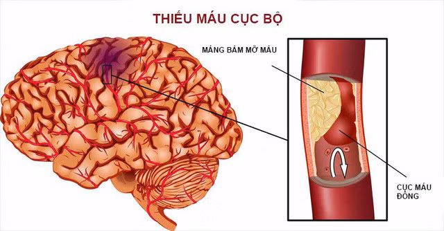 Thiếu máu cục bộ do huyết khối gây đột quỵ cần được xử lý cấp cứu