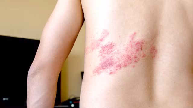 Bệnh zona thần kinh có thể lây qua các tổn thương mụn nước trên da.