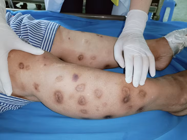 Các đốm nâu chi chít trên cơ thể người bệnh (Ảnh: Bệnh viện cung cấp).