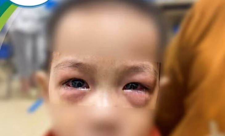 Một em bé bị đau mắt đỏ đến khám (Ảnh: Bệnh viện Nhi Trung ương).