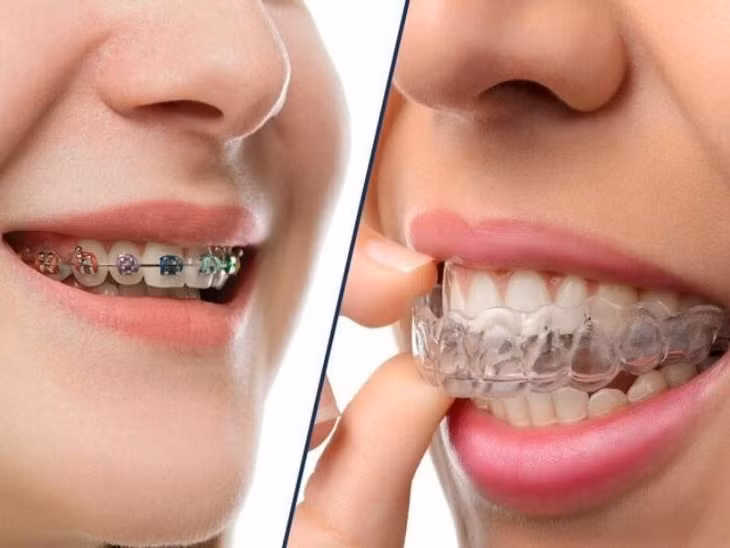 Niềng răng giúp cải thiện các khuyết điểm trên răng, mang đến gương mặt cân đối, hài hòa.
