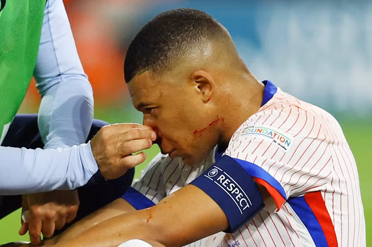 Mbappe dường như bị gãy mũi