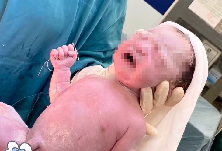 Em bé sơ sinh chào đời với chiếc vòng tránh thai của mẹ. Ảnh: BVCC.