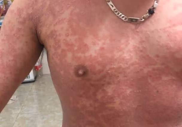 Em Tú bị vảy nến bong tróc toàn thân.