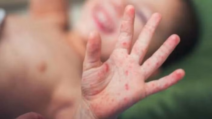 Viêm màng não có thể gây ra những biến chứng nguy hiểm cho trẻ (Ảnh: ST)
