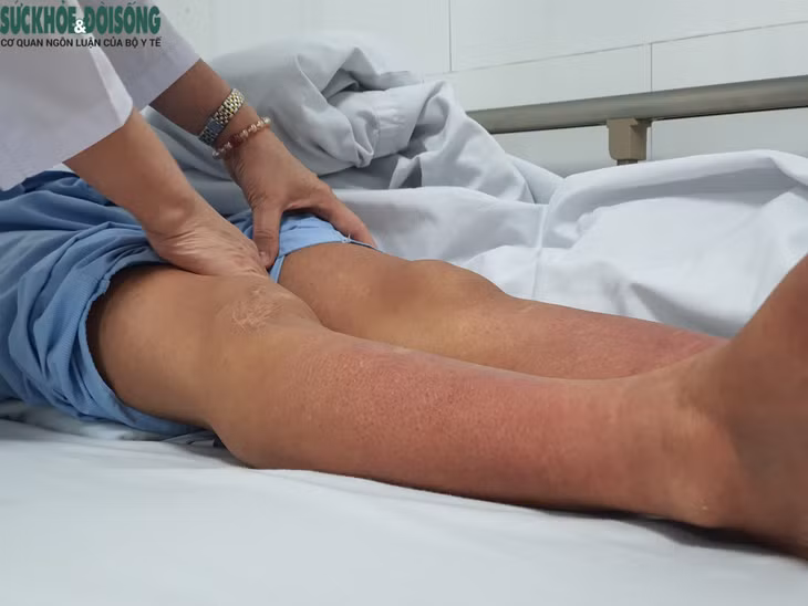 Một trường hợp xuất huyết dưới da nặng ở bệnh nhân sốt xuất huyết.