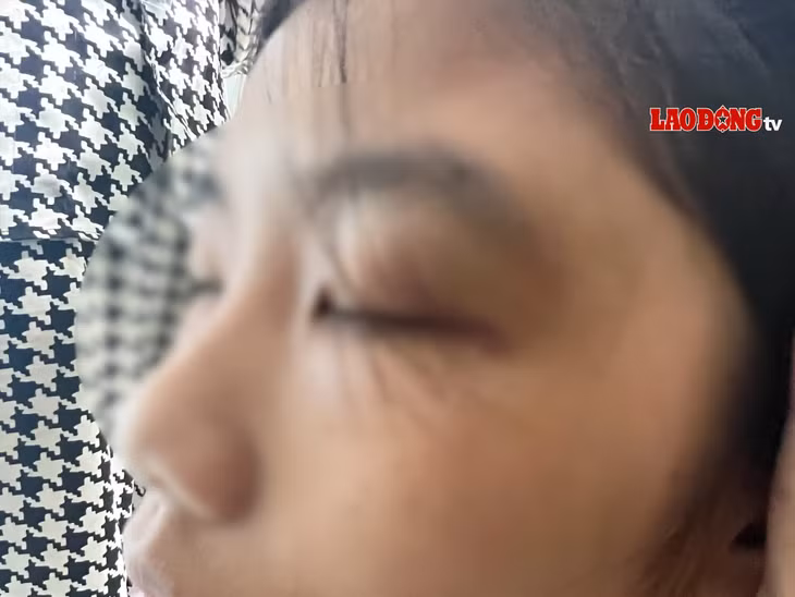 Mắt trái em M đã bị sưng và bầm. Ảnh: Hoài Luân