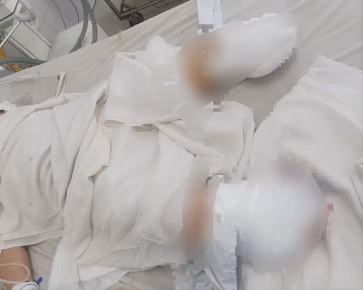 Nam công nhân bị cuốn vào máy trộn keo, bị gãy tay chân. Ảnh: Người nhà cung cấp