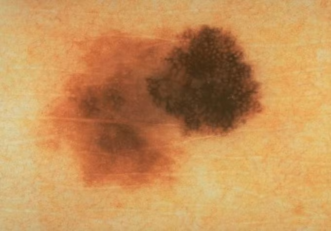Hình ảnh đặc trưng của nốt ruồi không đối xứng cảnh báo ung thư da. Ảnh: American Academy of Dermatology