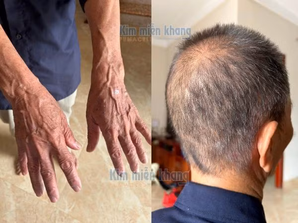 Ông Trạch đã sạch vảy nhờ Kim Miễn Khang.