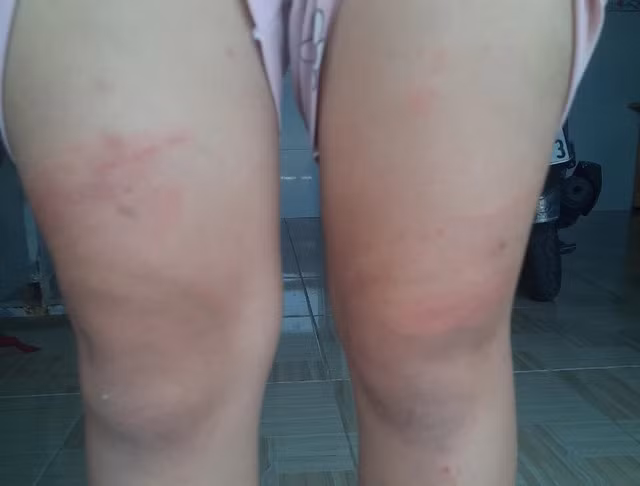 Hình ảnh đầu gối cháu H. bị Dung đánh, ảnh do người nhà cung cấp