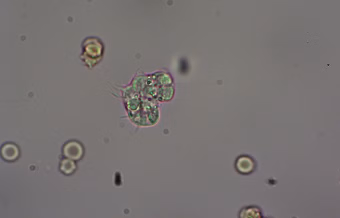 Amip Naegleria fowleri dưới kính hiển vi điện tử. Ảnh: Bệnh viện cung cấp