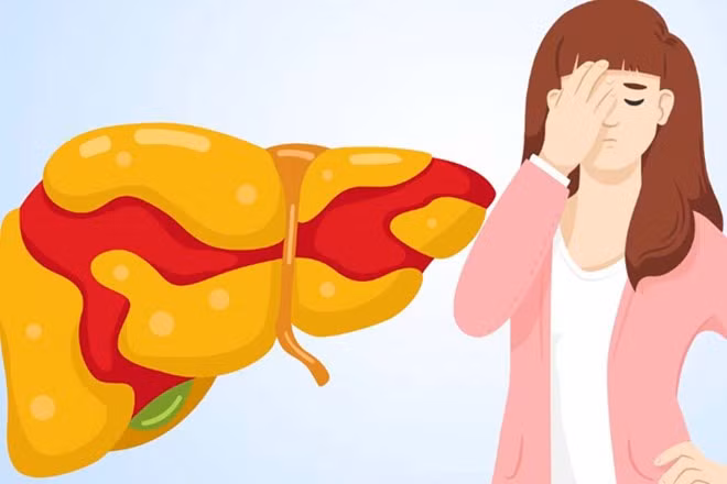 Gan nhiễm mỡ có thể là dấu hiệu cho thấy võng mạc đang chịu áp lực. Đồ họa: Thiện Nhân