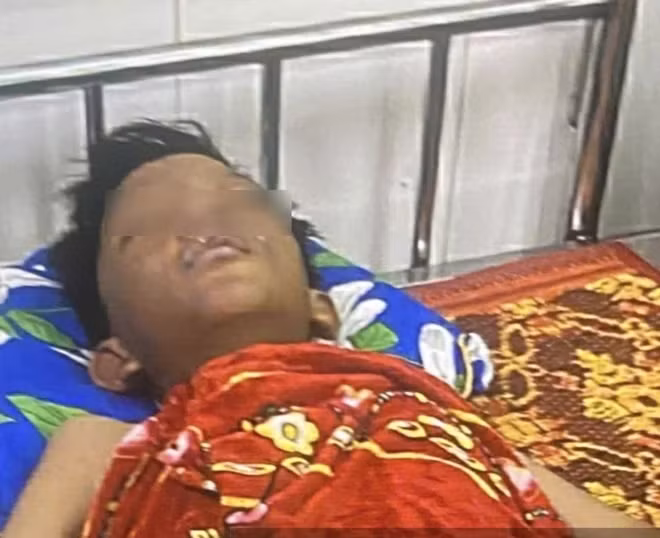 Em M. nhập viện trong tình trạng bị bỏng nhiều vùng trên cơ thể. Nguyên nhân nghi là pháo nổ tự chế gây ra.