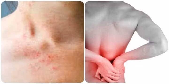 Da bị phát ban và đau lưng là những dấu hiệu cảnh báo suy thận nhẹ.