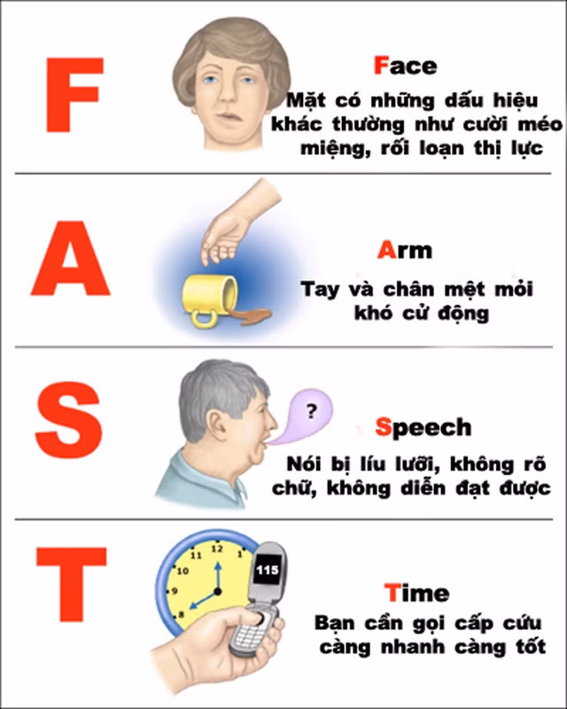Chú ý các dấu hiệu để nhận biết sớm cơn đột quỵ.