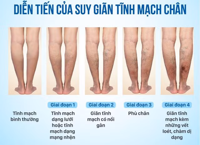 Người suy giãn tĩnh mạch chân cần thay đổi lối sống tránh đứng trong thời gian dài.