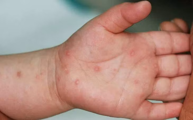 Trẻ em tựu trường có nguy cơ mắc các bệnh truyền nhiễm, nhất là sởi, tay chân miệng...