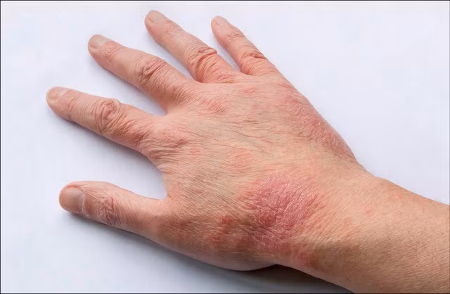 Viêm da dị ứng không phải là bệnh lý quá nguy hiểm nhưng có thể gây ảnh hưởng đến chất lượng cuộc sống của người bệnh.