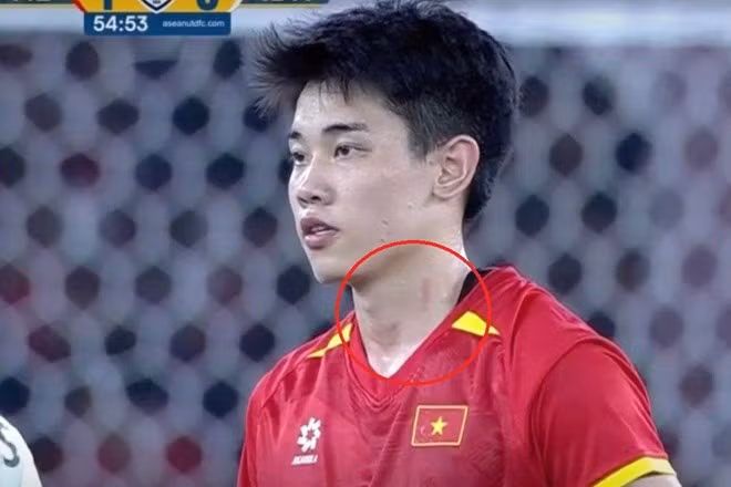 Vết xước trên cổ của Đình Bắc trong trận chung kết U23 Đông Nam Á 2025. Ảnh: Cắt từ video