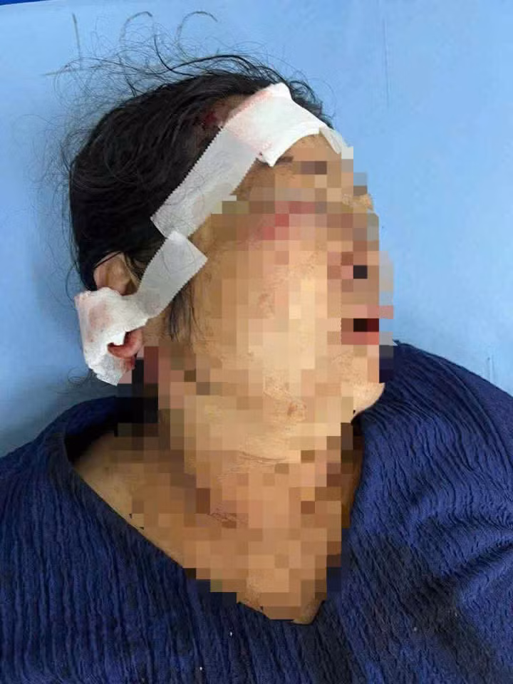 Người phụ nữ bị thương ở vùng trán, cổ và tai do nhóm thanh niên hành hung. Ảnh: Công an cung cấp