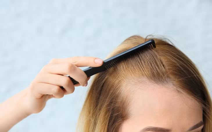Dấu hiệu hói đầu ở nữ.