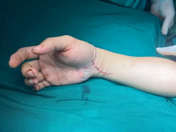 Cánh tay của bệnh nhân sau phẫu thuật. Ảnh: BSCC