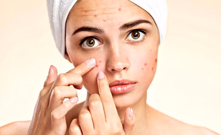 Mụn trứng cá ảnh hưởng đến cả thẩm mỹ lẫn tâm lý.