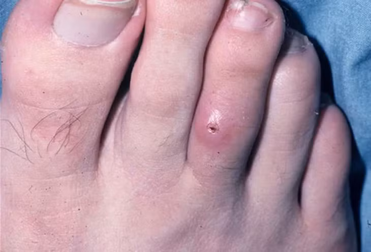 Vết thương do bệnh Myiasis - Ảnh: medscape