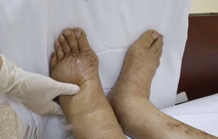 Đôi chân bị phù nặng của một bệnh nhân viêm gan, phải nhập viện trong tình trạng nguy kịch sau khi điều trị bằng thần dược "gia truyền" trên mạng xã hội. Ảnh: Do bệnh viện cung cấp.