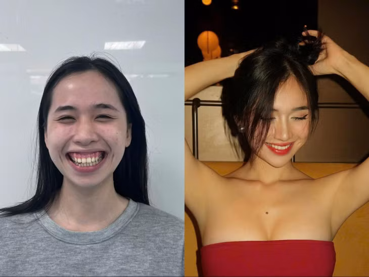 A Nha trước và sau khi phẫu thuật hàm hô thay đổi hoàn toàn.