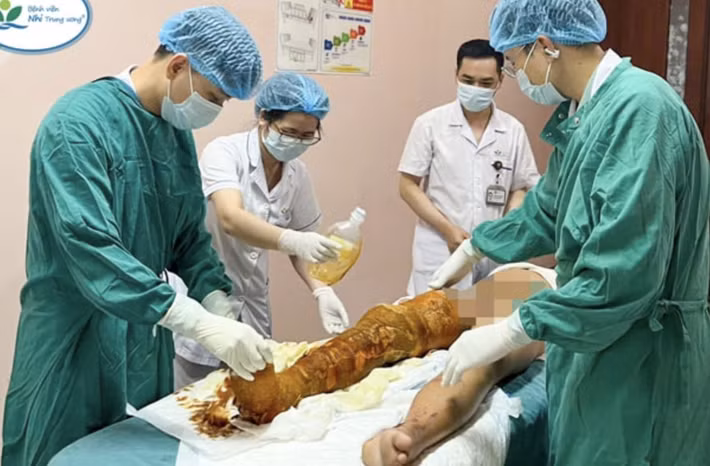 Bỏng cồn rất nguy hiểm và có thể gây tổn thương sâu và nhiễm trùng nặng nếu xử trí không đúng cách - Ảnh: BVCC