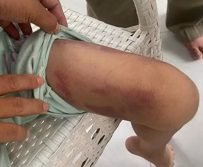 Bé gái 9 tuổi bị hành hạ bầm tím chân. Ảnh: Cơ quan chức năng cung cấp